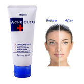 Mistine Acne Clear Facial Foam (Made in Thailand) 85g